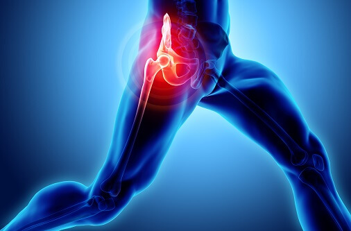What Is Piriformis Syndrome and How Can It Be Treated? 1 Piriformis Syndrome explained. SSEP professional Exercise and Sports Physiologists in Sydney NSW