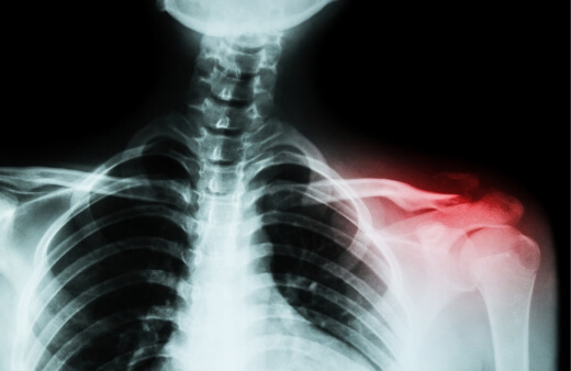 9 Common Soccer Injuries and Injury Prevention Tips 3 Clavicle fracture is a common soccer injury